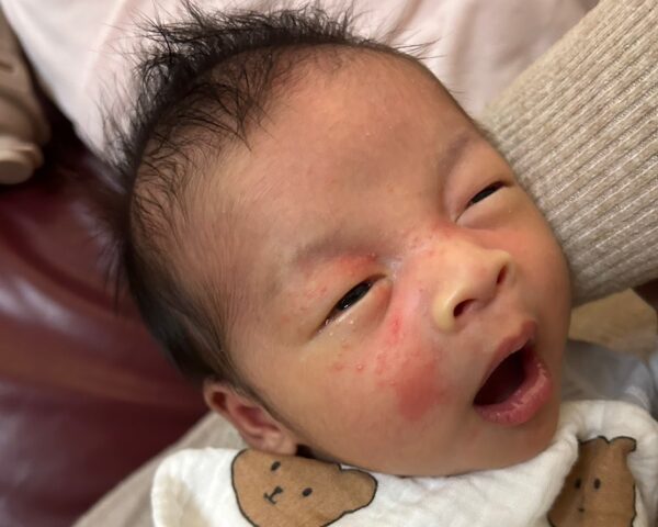 嬰兒臉上的小煩惱「新生兒痤瘡」
